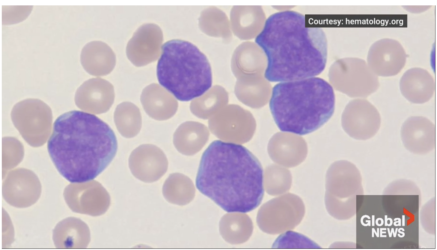 Global News coverage of CELLFiE at IWK